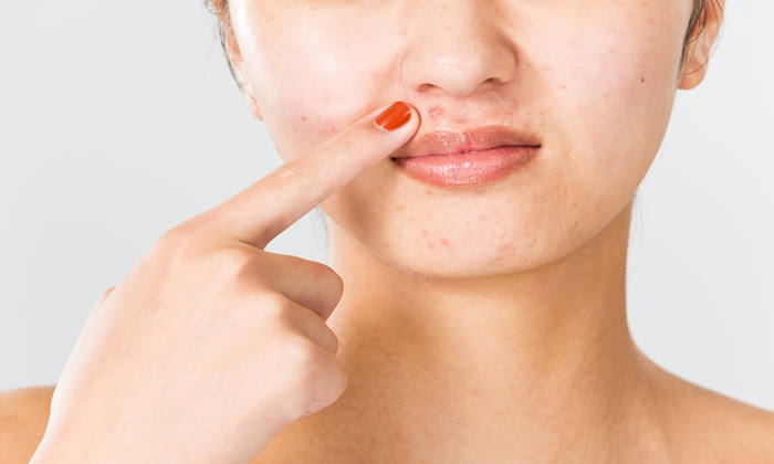 สิวขึ้นรอบปาก สาเหตุ อาการ วิธีรักษาและการป้องกัน