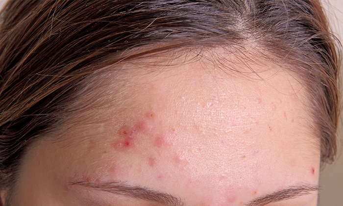 สิวขึ้นหน้าผาก สาเหตุ การรักษา และการป้องกัน