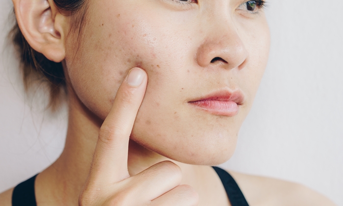 สิวผดที่แก้ม สาเหตุ วิธีรักษาและการป้องกัน