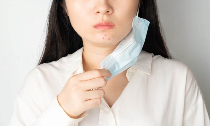 สิวมีกี่ประเภท และมีวิธีรักษาอย่างไร