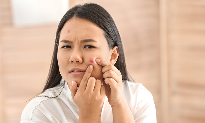 สิวอักเสบหัวหนอง สาเหตุ อาการ และการรักษา