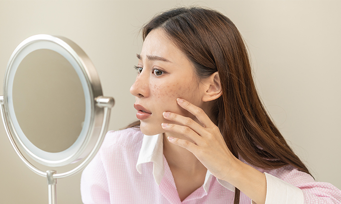 สิวใต้ผิวหนัง สาเหตุ อาการ และการรักษา