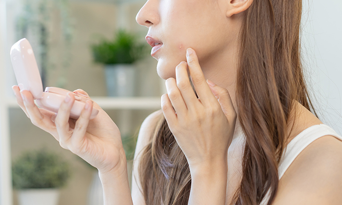 สิวไม่มีหัว สาเหตุ อาการ และการรักษา