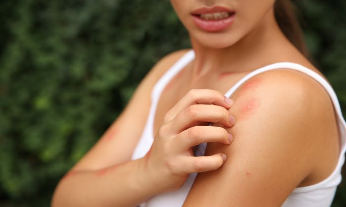 Dyshidrotic Eczema คืออะไร เกิดจากอะไร และรักษาอย่างไร