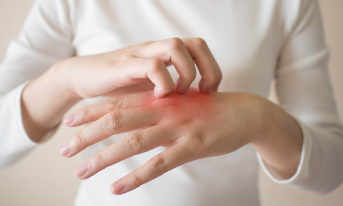 คุดทะราด คือโรคอะไร เป็นแล้วมีอาการอย่างไร