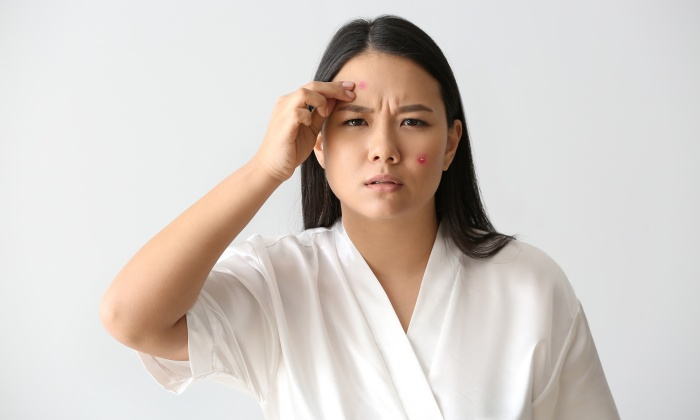 สิวหัวช้างเกิดจากอะไร รักษาและควรดูแลตนเองอย่างไร