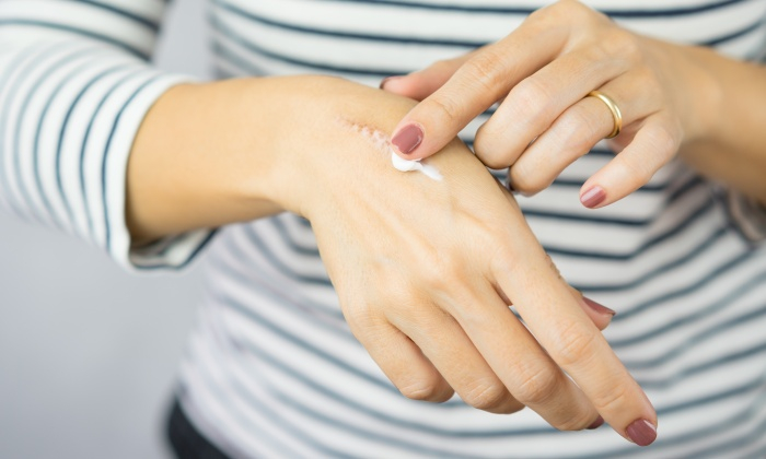 ยาทาแผลเป็น มียาอะไรบ้าง แต่ละอย่างมีฤทธิ์อย่างไร