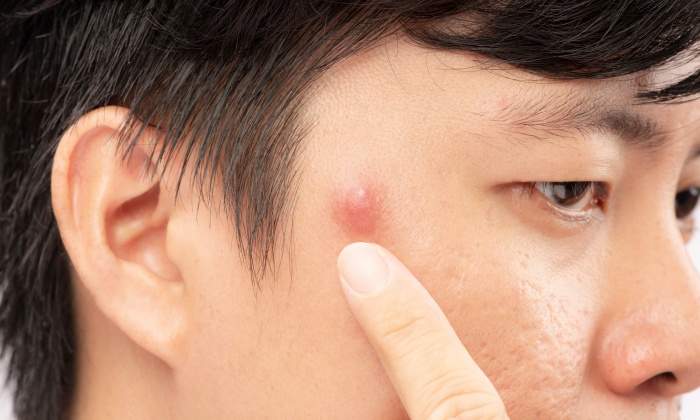 ชนิดของสิว และความเข้าใจผิดเกี่ยวกับสิว