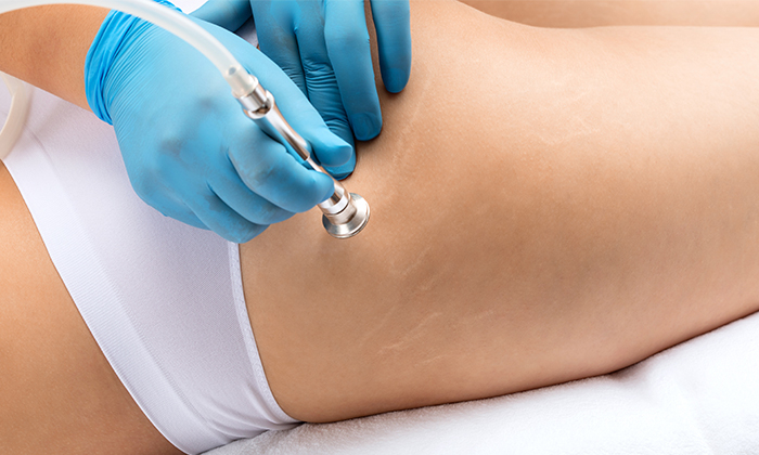 ก้นลาย เกิดจากอะไร ควรรักษาและป้องกันอย่างไร