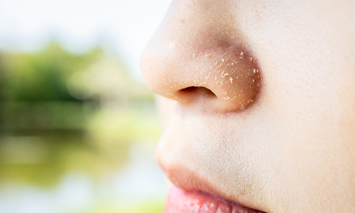 จมูกลอก อาการ สาเหตุ และการดูแลผิว