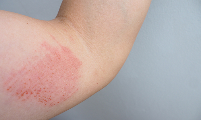 จุด แดง ใต้ ผิวหนัง ไม่ คัน อาการ สาเหตุและการรักษา