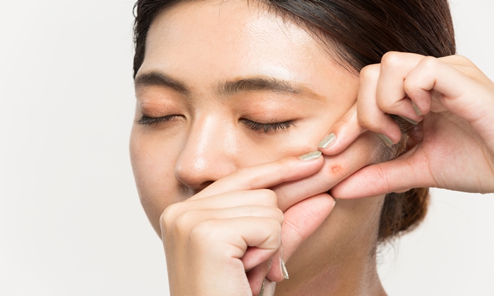 วิธีรักษาสิวหัวช้าง ทำได้อย่างไรบ้าง