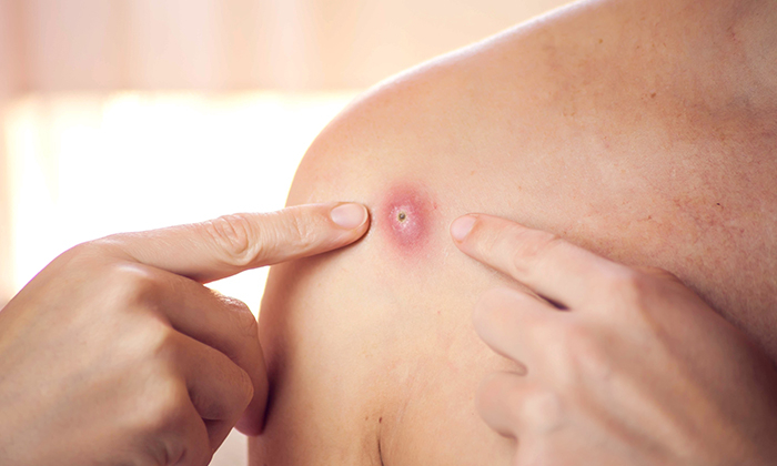 เป็นฝีบ่อย บ่ง บอก อะไร ได้บ้าง ควรดูแลตัวเองอย่างไร