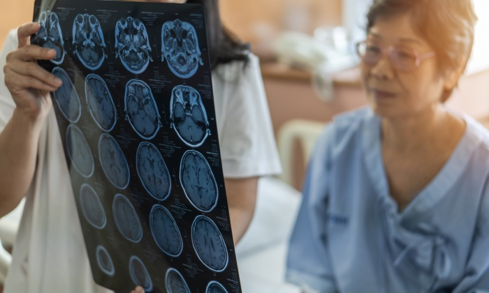 เส้นเลือดในสมองตีบ สาเหตุ อาการ และการรักษา