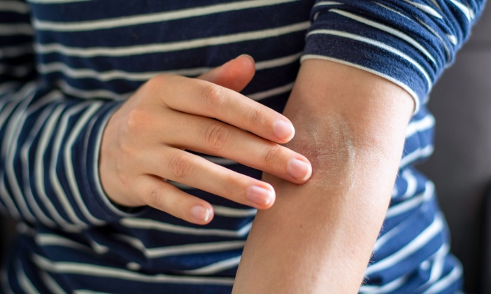 อาการคันยุบยิบ ตามตัว ไม่มี ผื่น เกิดจากสาเหตุอะไรได้บ้าง