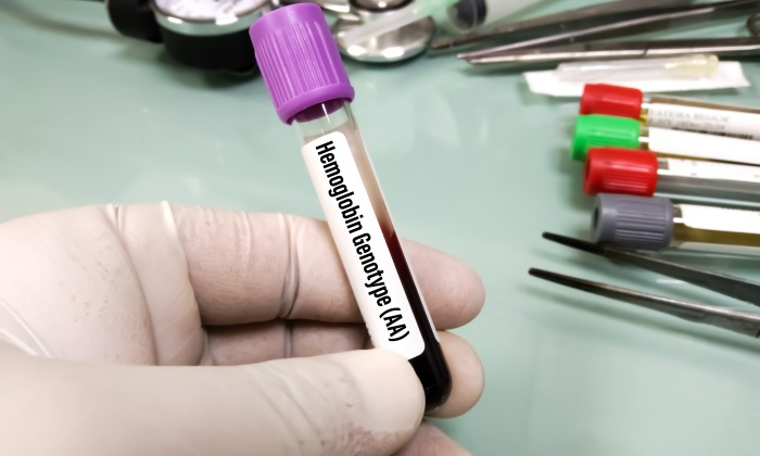 โรคธาลัสซีเมีย รักษาให้หายได้ไหม เป็นแล้วดูแลตัวเองอย่างไร