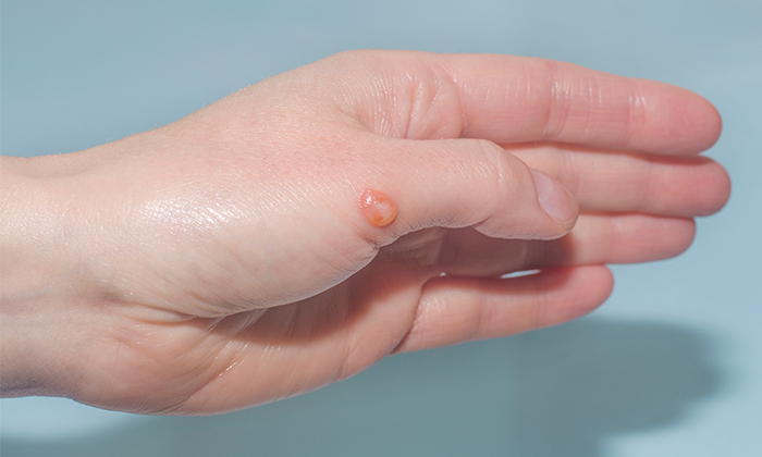ตุ่มใสที่นิ้ว สาเหตุ อาการและการรักษา