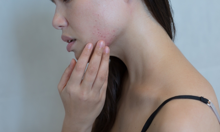 รอยแดงจากสิว วิธีรักษา และดูแลให้รอยดำจางอย่างเห็นผล