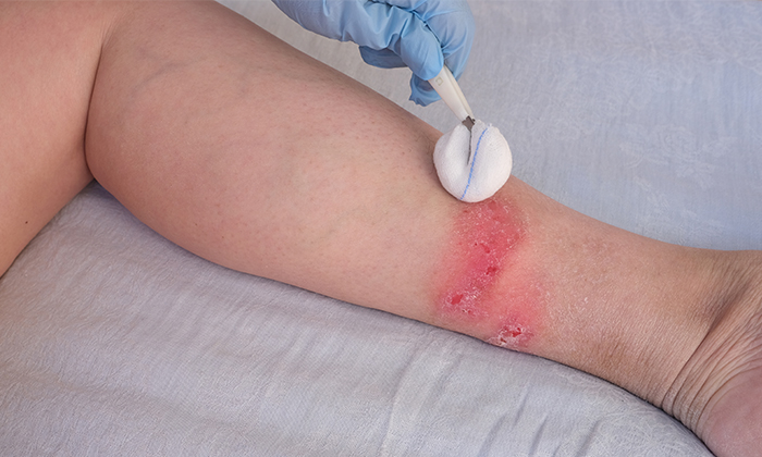 รักษา แผล เบาหวาน ทำได้อย่างไร และควรป้องกันอย่างไรไม่ให้เกิดแผล