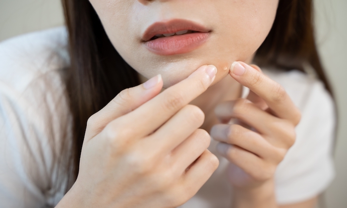 สิวอุดตันเกิดจากอะไร และรักษาได้อย่างไร