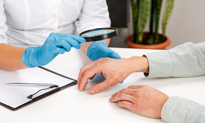 เรื้อนกวาง (Psoriasis) คืออะไร เกิดจากอะไร และรักษาได้อย่างไร