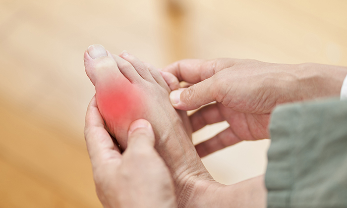 โรคเก๊าท์ อาการ ปัจจัยเสี่ยง และการป้องกัน