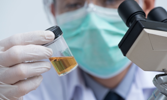 ลักษณะ ฉี่ ของคนเป็น เบาหวาน เป็นอย่างไร