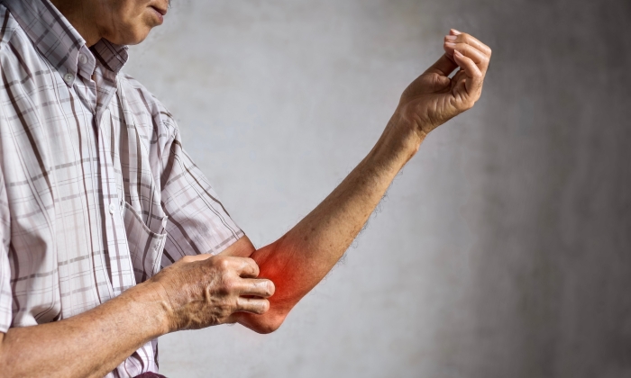 สะเก็ดเงิน อาการ และการดูแลตัวเองเบื้องต้น