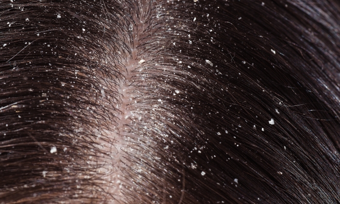 หนังศีรษะแห้ง ลอก ดูแลตัวเองอย่างไร