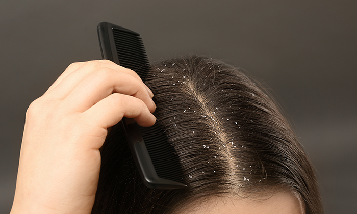 หนังหัวลอก เกิดจากอะไร และวิธีการดูแลรักษา