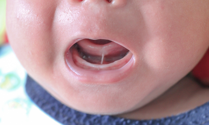 Tongue Tie คือ อะไร อาการและการรักษา