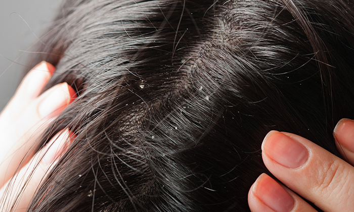 รังแค เปียก เกิดจากอะไร ควรรักษาอย่างไร