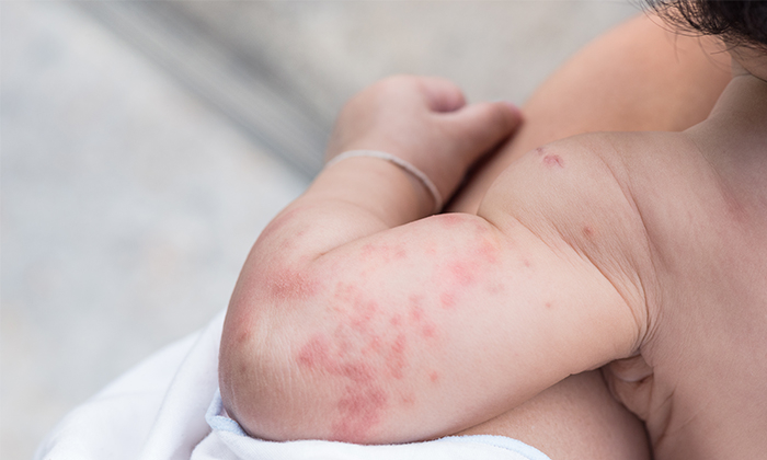 ลูกเป็นผื่นเม็ดเล็กๆ ปัญหาผิวหนังที่พบได้บ่อยในเด็กเล็ก