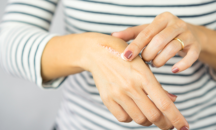 วิธีทําให้แผลแห้ง ตกสะเก็ดเร็ว เพื่อให้ผิวกลับมาเรียบเนียน