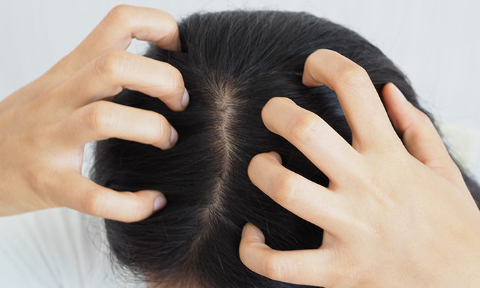 หนังหัวลอก เป็นแผ่น ทําไงดี และควรป้องกันอย่างไร