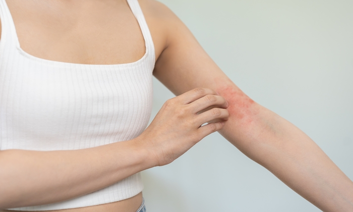 ตุ่มอับชื้น สาเหตุ อาการ วิธีรักษาและการป้องกัน