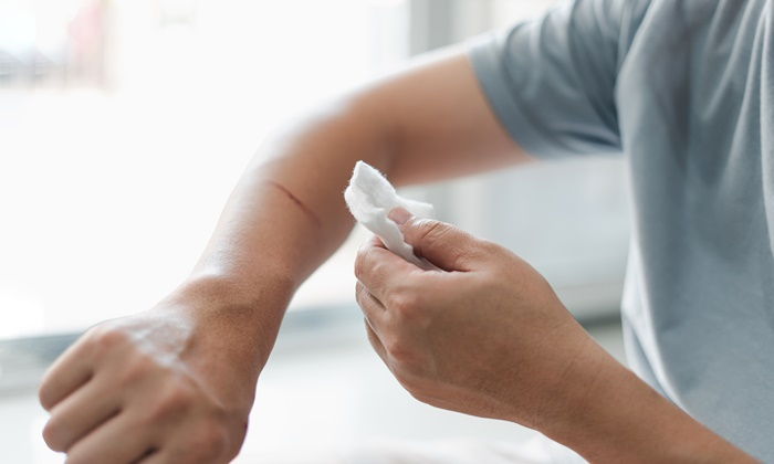 มีดบาด ต้องทำอย่างไร? วิธีรักษาแผลมีดบาดและรอยไหม้