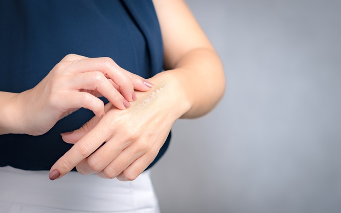 โดนน้ำมันลวก ปฐมพยาบาล อย่างไรให้ปลอดภัย